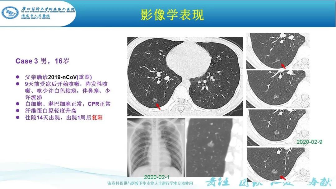 【PPT】新冠病毒肺炎影像学表现