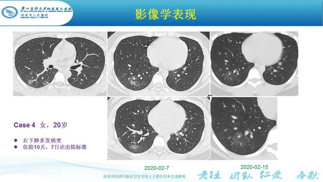【PPT】新冠病毒肺炎影像学表现