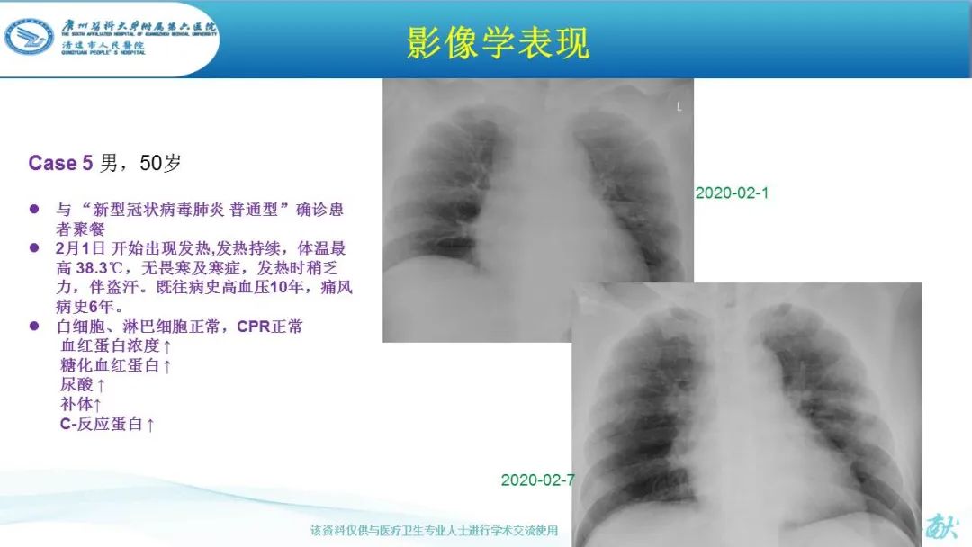 【PPT】新冠病毒肺炎影像学表现