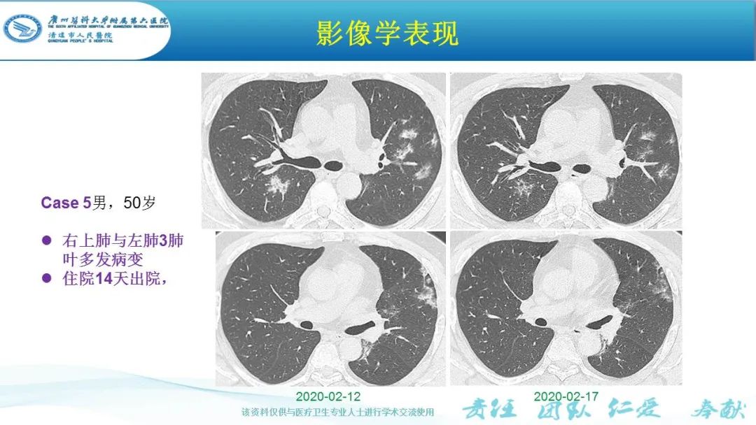 【PPT】新冠病毒肺炎影像学表现