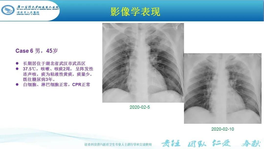 【PPT】新冠病毒肺炎影像学表现
