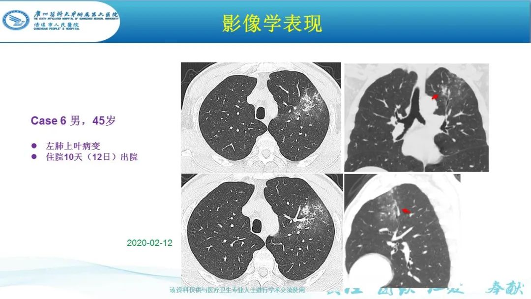 【PPT】新冠病毒肺炎影像学表现