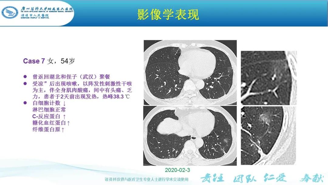 【PPT】新冠病毒肺炎影像学表现