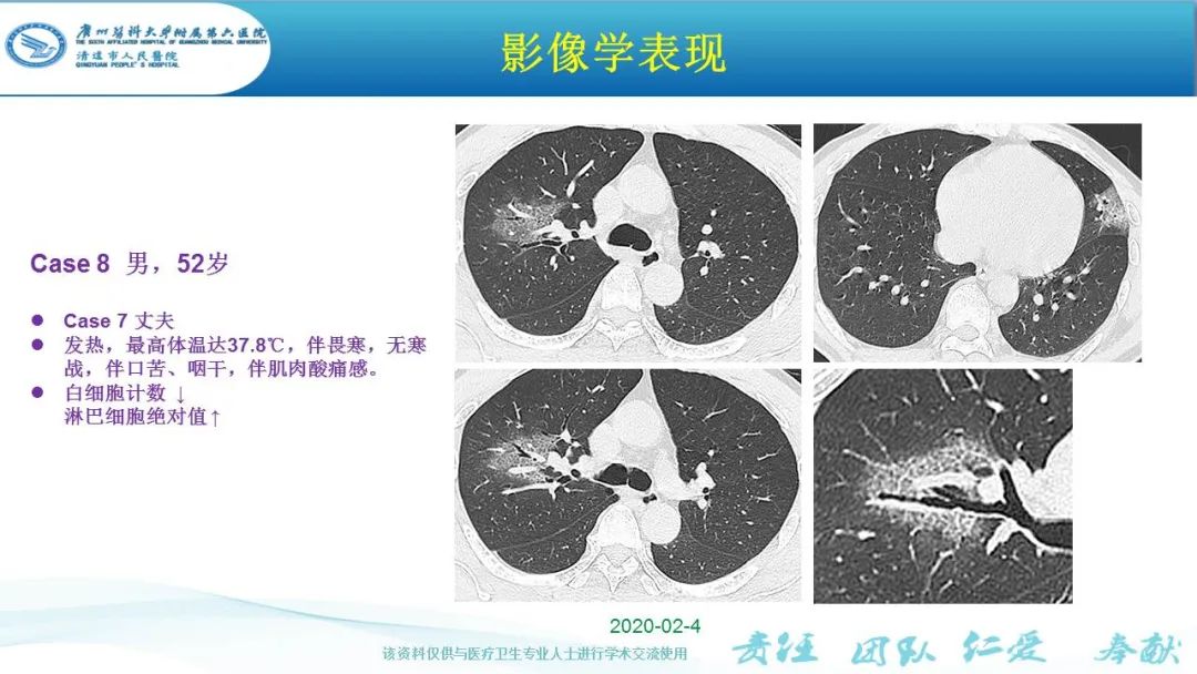 【PPT】新冠病毒肺炎影像学表现