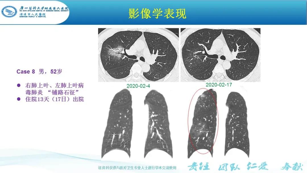 【PPT】新冠病毒肺炎影像学表现