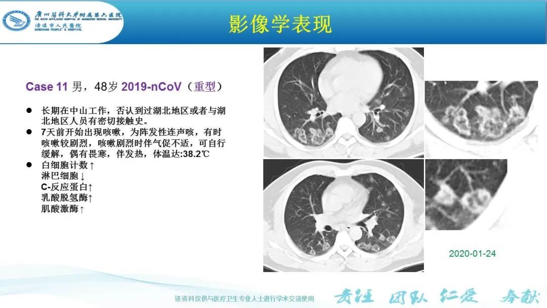 【PPT】新冠病毒肺炎影像学表现