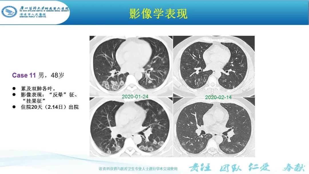 【PPT】新冠病毒肺炎影像学表现
