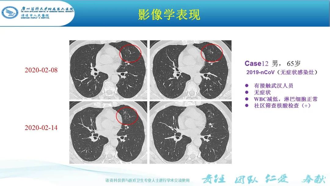 【PPT】新冠病毒肺炎影像学表现