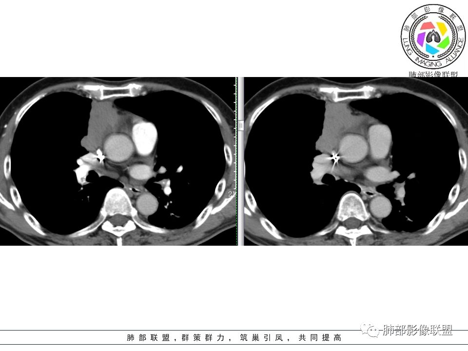 【病例】纵隔胸腺瘤1例CT影像讨论 【病例】纵隔胸腺瘤1例CT影像讨论