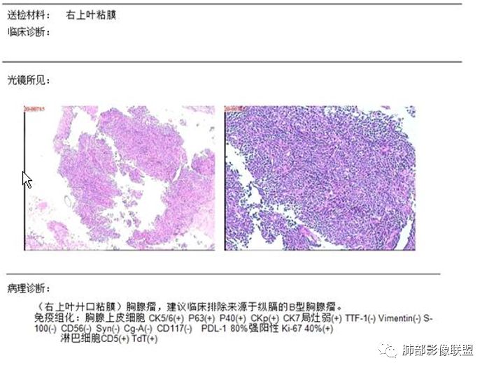 【病例】纵隔胸腺瘤1例CT影像讨论 【病例】纵隔胸腺瘤1例CT影像讨论