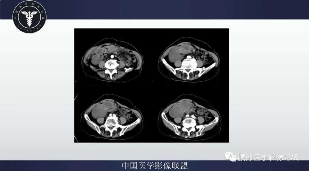 【病例】阑尾黏液腺癌1例CT及MR影像 【病例】阑尾黏液腺癌1例CT及MR影像