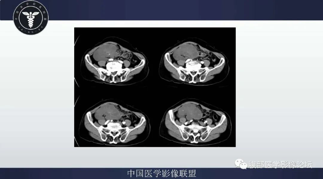 【病例】阑尾黏液腺癌1例CT及MR影像 【病例】阑尾黏液腺癌1例CT及MR影像