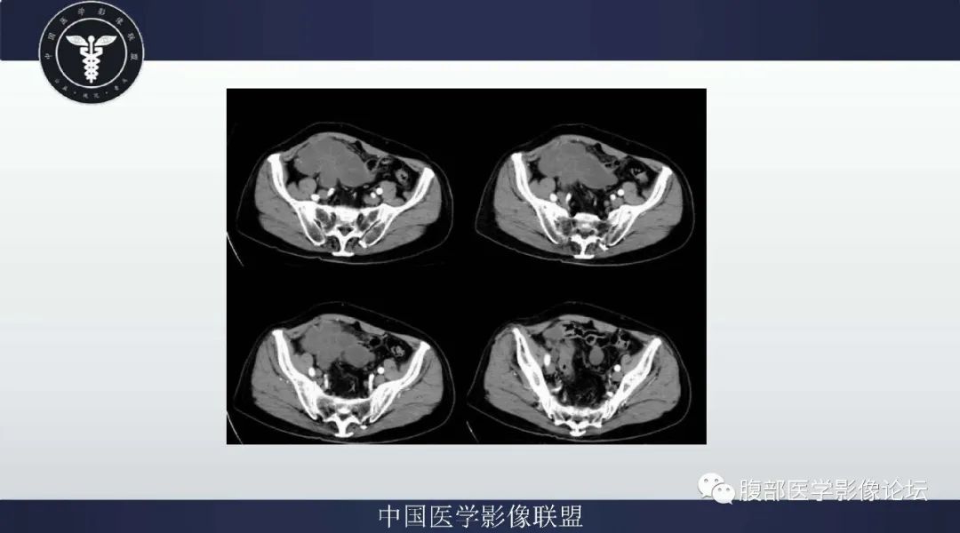 【病例】阑尾黏液腺癌1例CT及MR影像 【病例】阑尾黏液腺癌1例CT及MR影像