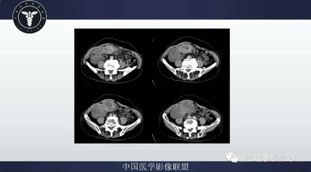 【病例】阑尾黏液腺癌1例CT及MR影像 【病例】阑尾黏液腺癌1例CT及MR影像
