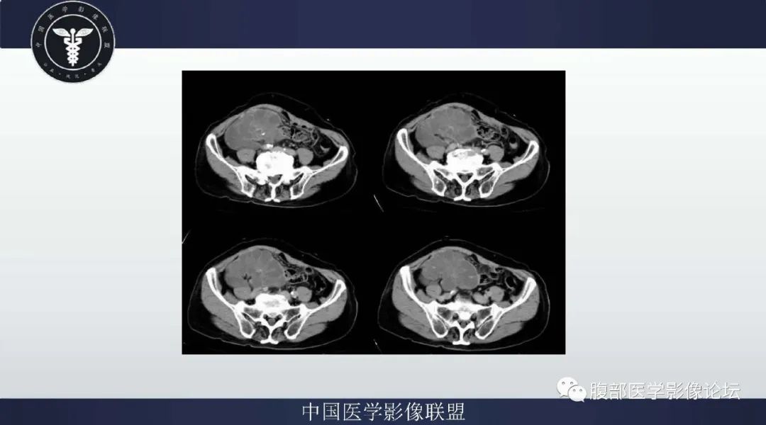 【病例】阑尾黏液腺癌1例CT及MR影像 【病例】阑尾黏液腺癌1例CT及MR影像