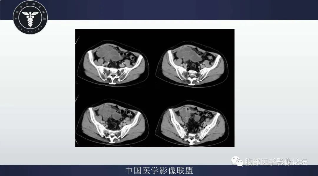 【病例】阑尾黏液腺癌1例CT及MR影像 【病例】阑尾黏液腺癌1例CT及MR影像
