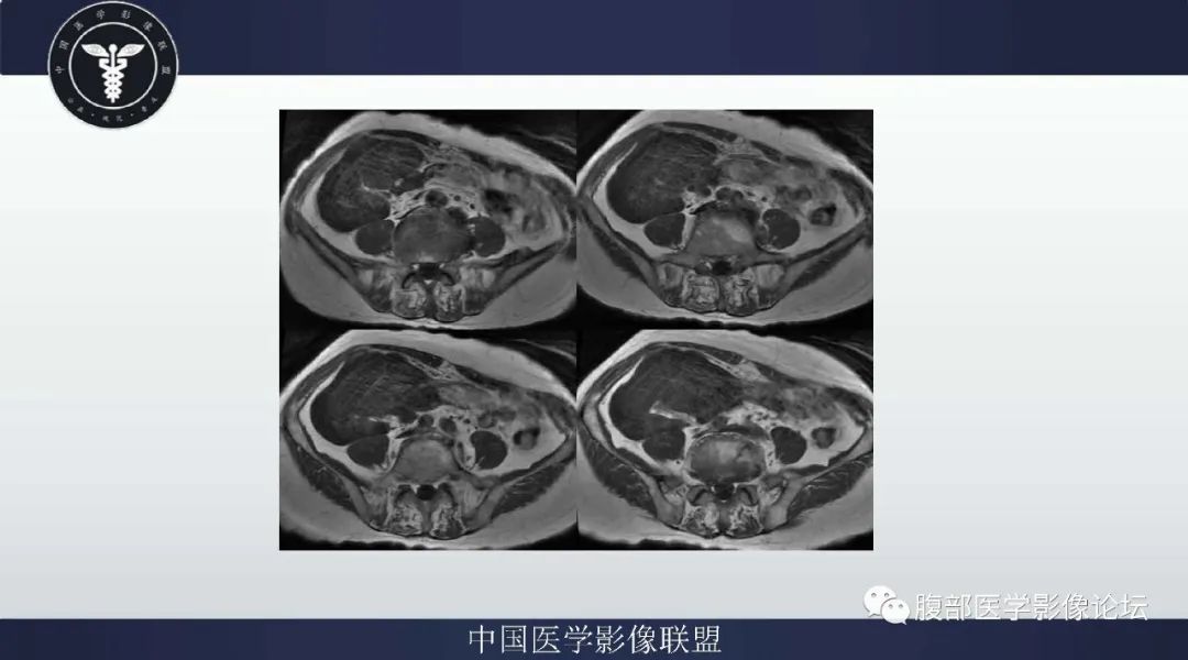 【病例】阑尾黏液腺癌1例CT及MR影像 【病例】阑尾黏液腺癌1例CT及MR影像