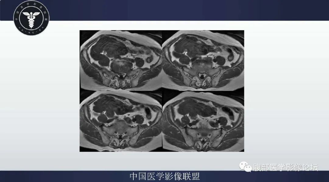 【病例】阑尾黏液腺癌1例CT及MR影像 【病例】阑尾黏液腺癌1例CT及MR影像