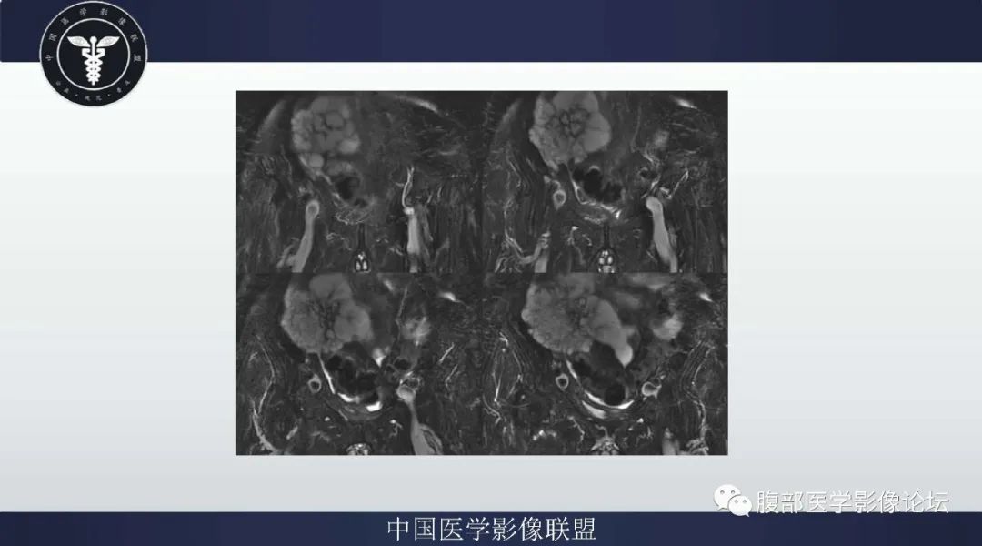【病例】阑尾黏液腺癌1例CT及MR影像 【病例】阑尾黏液腺癌1例CT及MR影像