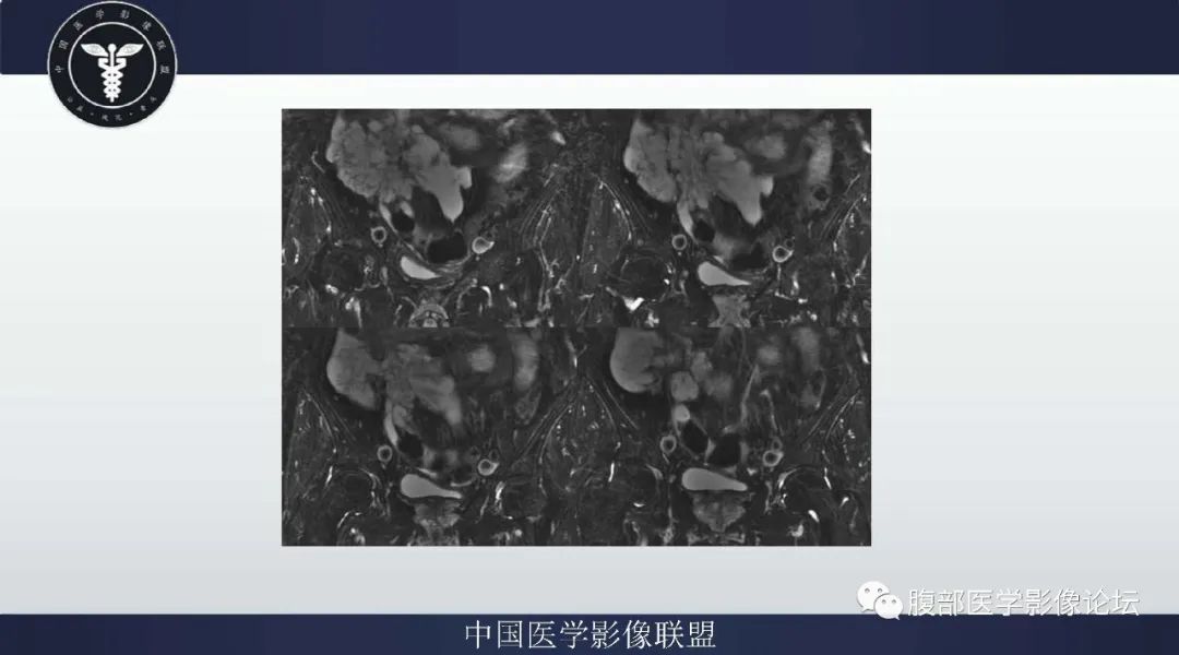 【病例】阑尾黏液腺癌1例CT及MR影像 【病例】阑尾黏液腺癌1例CT及MR影像