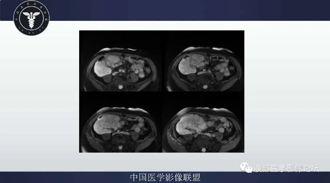 【病例】阑尾黏液腺癌1例CT及MR影像 【病例】阑尾黏液腺癌1例CT及MR影像