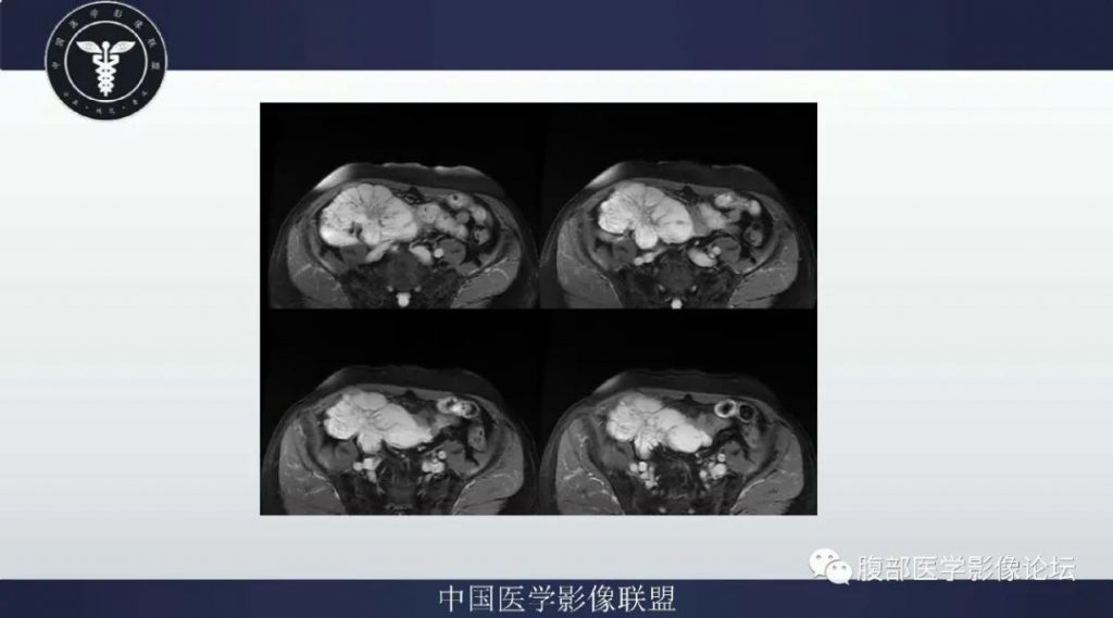【病例】阑尾黏液腺癌1例CT及MR影像