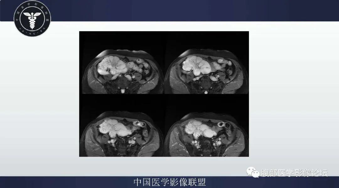 【病例】阑尾黏液腺癌1例CT及MR影像 【病例】阑尾黏液腺癌1例CT及MR影像