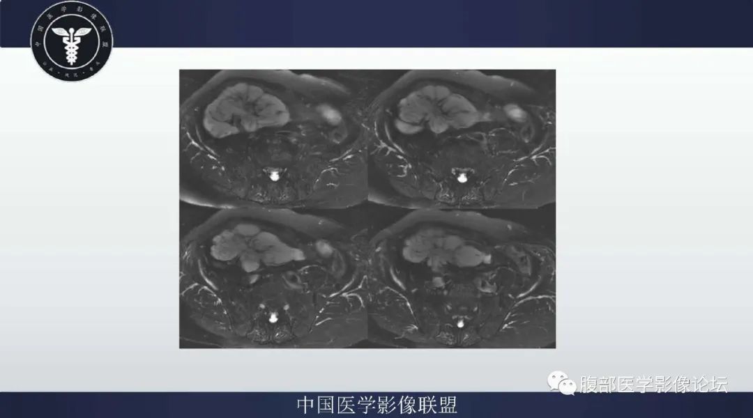 【病例】阑尾黏液腺癌1例CT及MR影像 【病例】阑尾黏液腺癌1例CT及MR影像