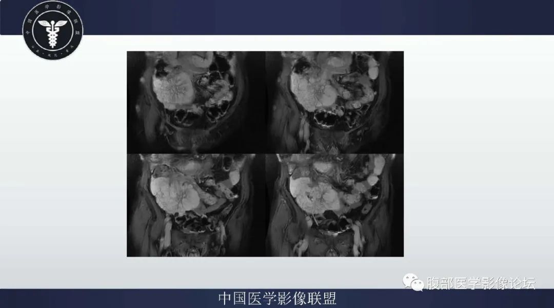 【病例】阑尾黏液腺癌1例CT及MR影像 【病例】阑尾黏液腺癌1例CT及MR影像