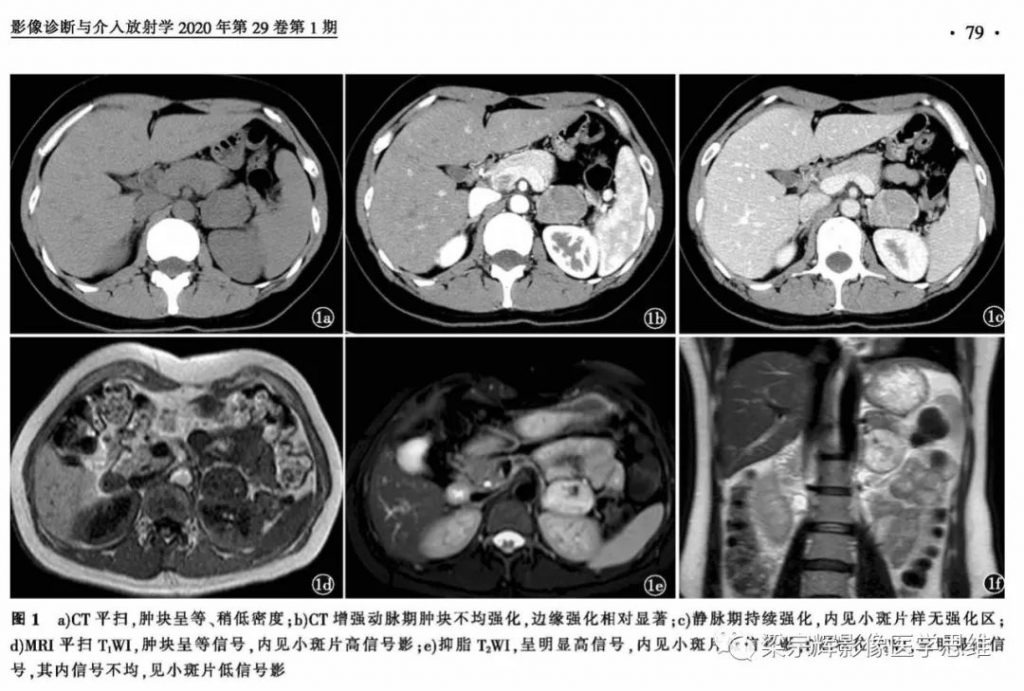 【病例】肾上腺嗜铬细胞瘤1例CT影像诊断思维
