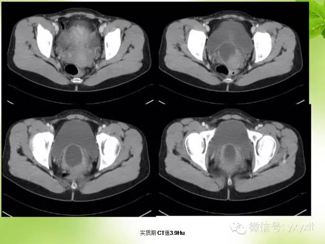 【病例】苗勒管囊肿1例CT影像表现 【病例】苗勒管囊肿1例CT影像表现