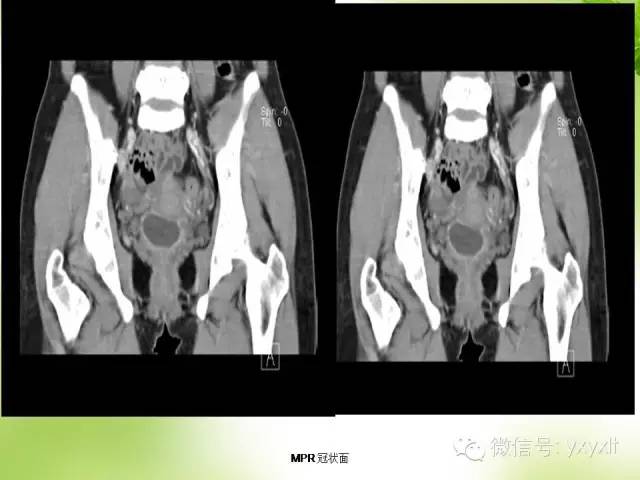 【病例】苗勒管囊肿1例CT影像表现 【病例】苗勒管囊肿1例CT影像表现