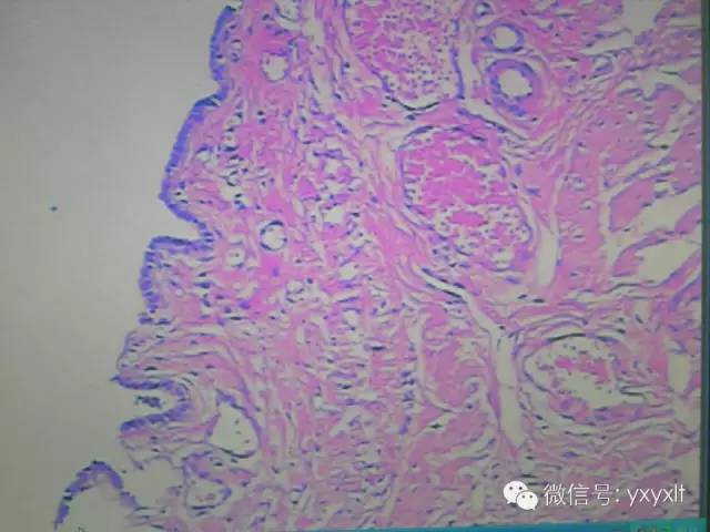 【病例】苗勒管囊肿1例CT影像表现 【病例】苗勒管囊肿1例CT影像表现