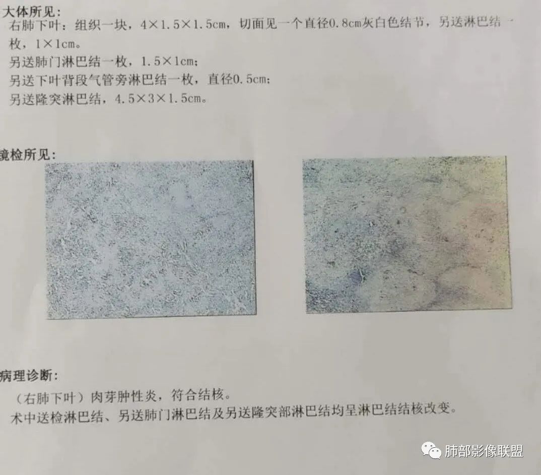 【病例】结核居然也能有晕征 【病例】结核居然也能有晕征