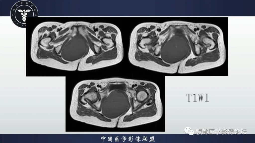 【病例】盆腔囊性成熟性畸胎瘤1例MR
