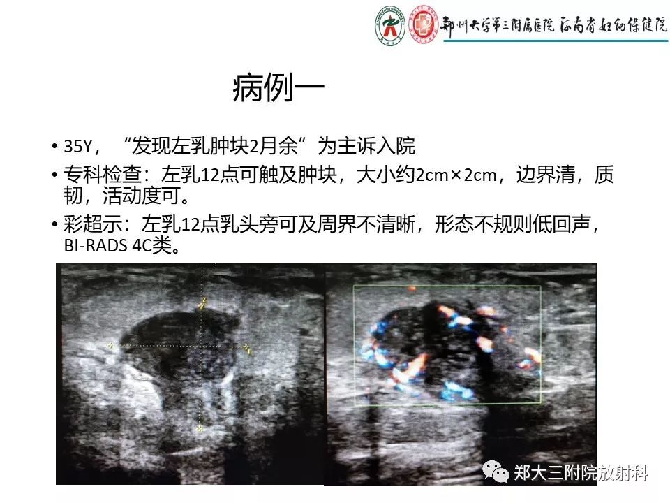 【PPT】非哺乳期乳腺炎症与炎性乳癌的影像鉴别诊断