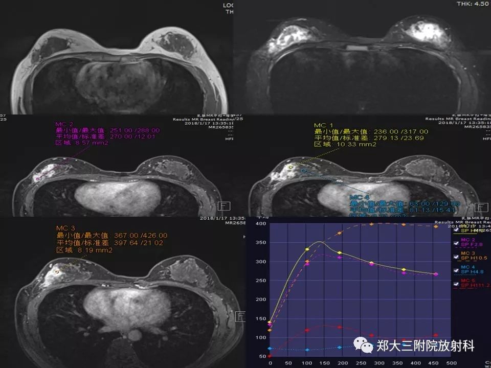 【PPT】非哺乳期乳腺炎症与炎性乳癌的影像鉴别诊断