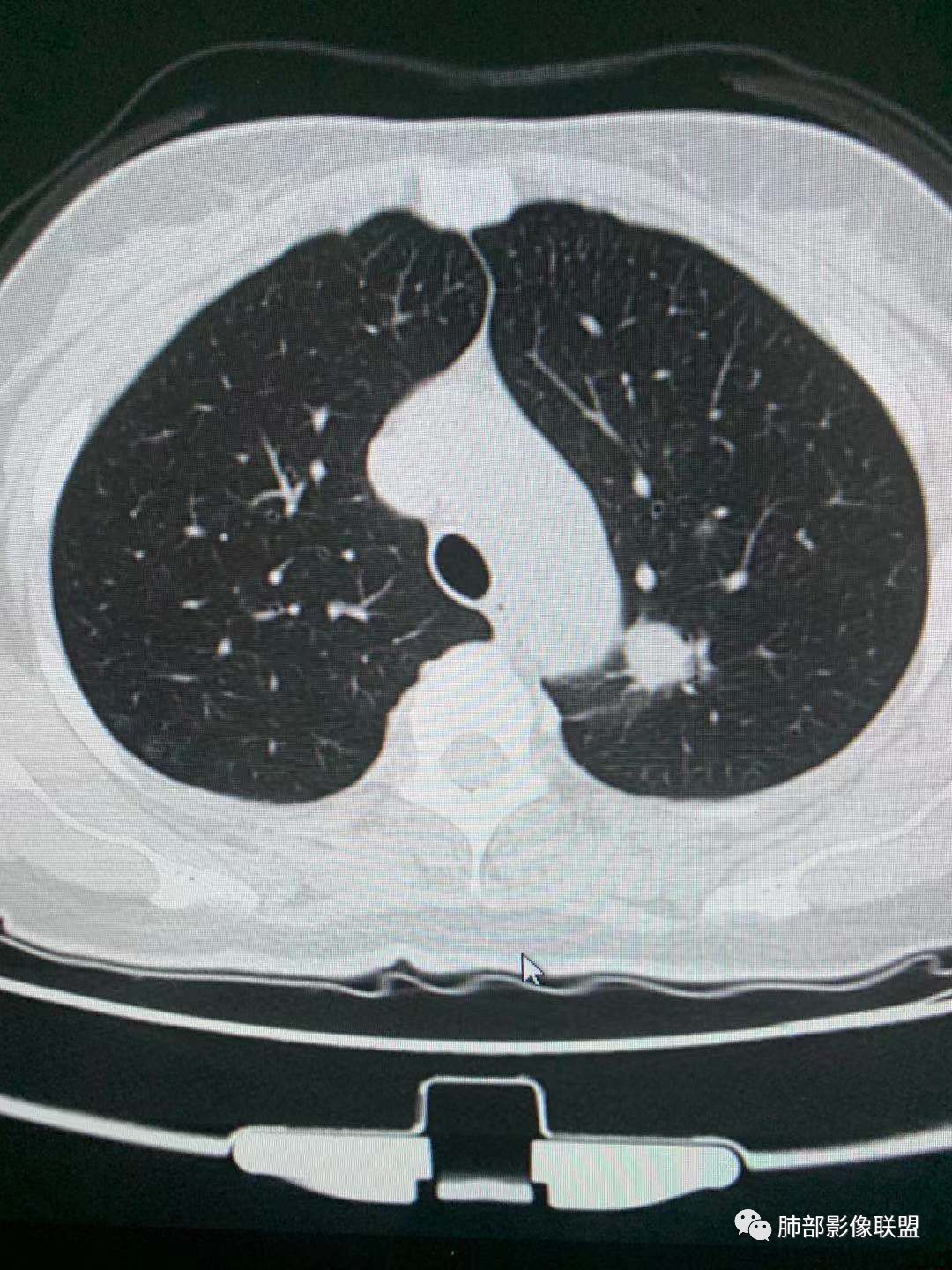 【病例】犹抱琵笆半遮面的肺腺癌 【病例】犹抱琵笆半遮面的肺腺癌