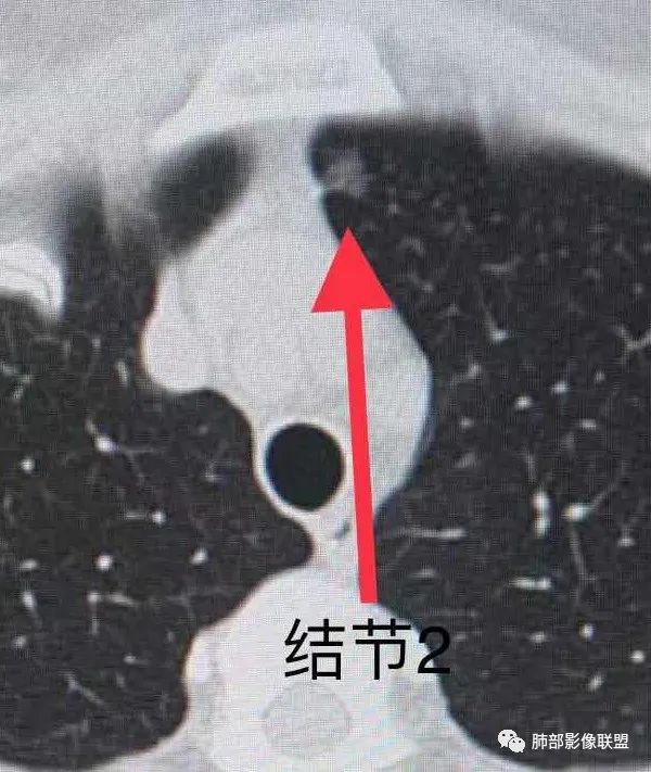 【病例】犹抱琵笆半遮面的肺腺癌 【病例】犹抱琵笆半遮面的肺腺癌