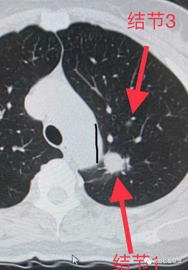 【病例】犹抱琵笆半遮面的肺腺癌 【病例】犹抱琵笆半遮面的肺腺癌