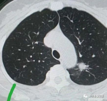 【病例】犹抱琵笆半遮面的肺腺癌 【病例】犹抱琵笆半遮面的肺腺癌