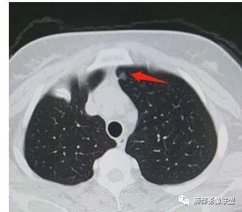 【病例】犹抱琵笆半遮面的肺腺癌 【病例】犹抱琵笆半遮面的肺腺癌