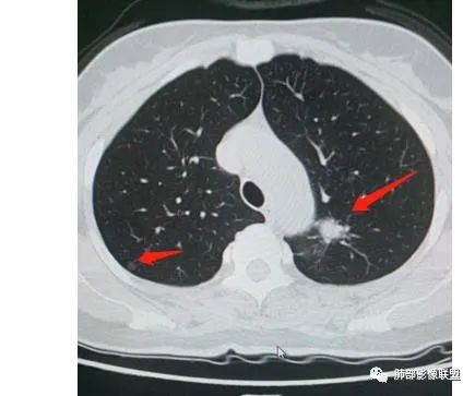 【病例】犹抱琵笆半遮面的肺腺癌 【病例】犹抱琵笆半遮面的肺腺癌