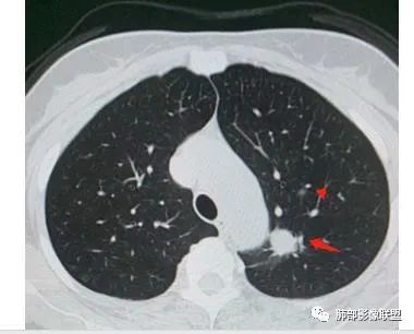 【病例】犹抱琵笆半遮面的肺腺癌 【病例】犹抱琵笆半遮面的肺腺癌