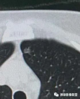 【病例】犹抱琵笆半遮面的肺腺癌 【病例】犹抱琵笆半遮面的肺腺癌