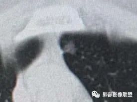 【病例】犹抱琵笆半遮面的肺腺癌 【病例】犹抱琵笆半遮面的肺腺癌