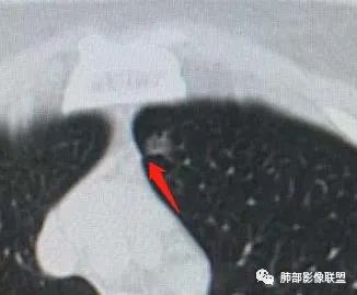 【病例】犹抱琵笆半遮面的肺腺癌 【病例】犹抱琵笆半遮面的肺腺癌