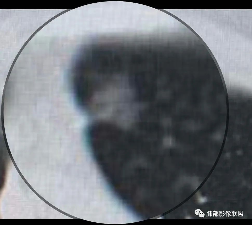 【病例】犹抱琵笆半遮面的肺腺癌 【病例】犹抱琵笆半遮面的肺腺癌