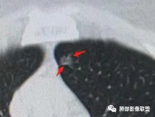 【病例】犹抱琵笆半遮面的肺腺癌 【病例】犹抱琵笆半遮面的肺腺癌