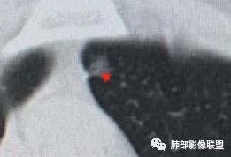 【病例】犹抱琵笆半遮面的肺腺癌 【病例】犹抱琵笆半遮面的肺腺癌